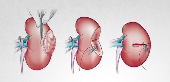 Nephron Sparing Surgery